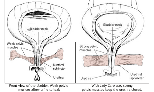 Lady Care Vaginal Weights Lady Care are selfpositioning so you are 